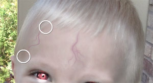 vampire photos forehead veins